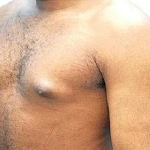 Men with enlarged breasts face higher risk of breast cancer – Expert 1 IMG 5375